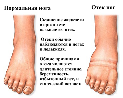 отек ног